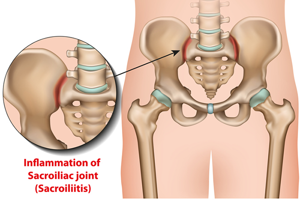 Dealing with SI Joint Pain: Effective Strategies and Common Mistakes to Avoid