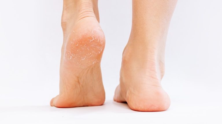 Could Your Exercise Routine Be Causing Your Feet to Peel?